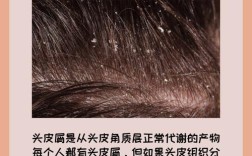 头皮屑反复怎么彻底解决？