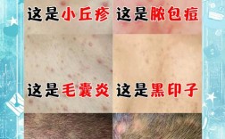 生活常识真能治好毛囊炎吗？