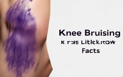 膝盖摔紫了怎么办？小常识速看！
