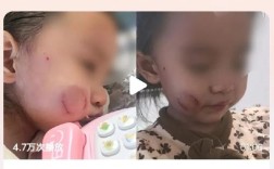 儿童安全教育咬伤