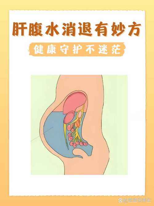 关于腹水的一些常识