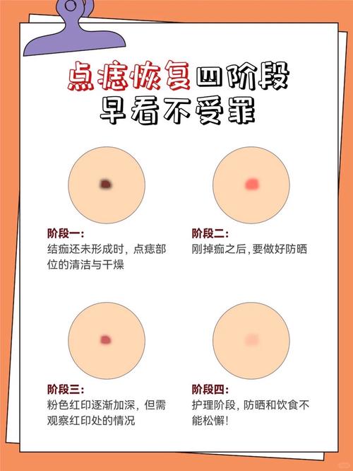 怎么可以少长痣常识