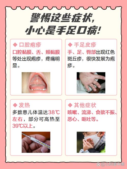幼儿夏季手足口小常识
